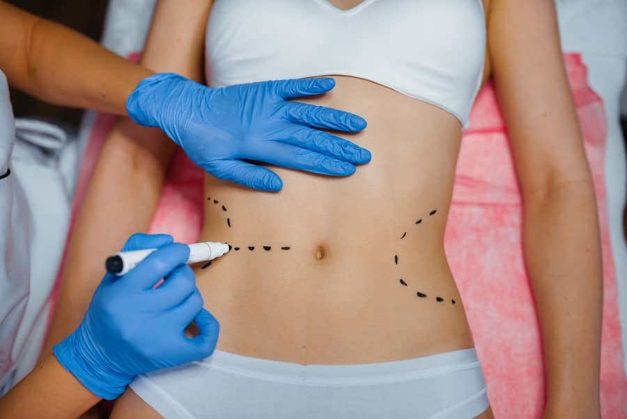 Abdominoplastia